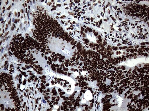 Immunohistochemical staining of paraffin-embedded Adenocarcinoma of Human colon tissue using anti-SH3BGRL mouse monoclonal antibody. Heat-induced epitope retrieval by EDTA solution buffer pH 8.0 at 120Â°C for 3 min.