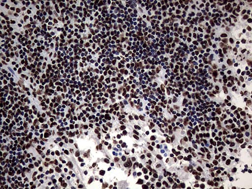 Immunohistochemical staining of paraffin-embedded Carcinoma of Human lung tissue using anti-SH3BGRL mouse monoclonal antibody. Heat-induced epitope retrieval by EDTA solution buffer pH 8.0 at 120Â°C for 3 min.