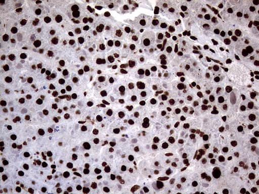 Immunohistochemical staining of paraffin-embedded Carcinoma of Human liver tissue using anti-SH3BGRL mouse monoclonal antibody. Heat-induced epitope retrieval by EDTA solution buffer pH 8.0 at 120Â°C for 3 min.