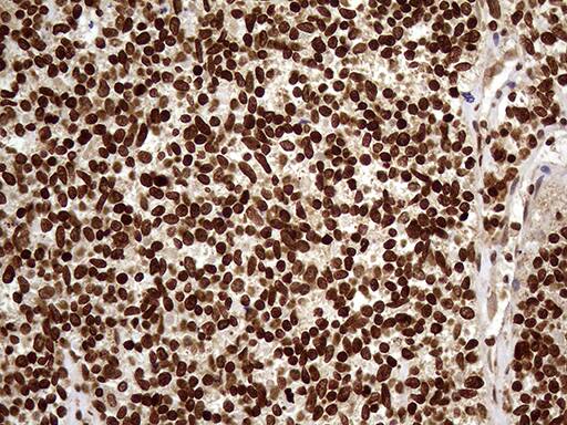 Immunohistochemical staining of paraffin-embedded Carcinoma of Human kidney tissue using anti-DDX19A mouse monoclonal antibody. Heat-induced epitope retrieval by EDTA solution buffer pH 8.0 at 120Â°C for 3 min.