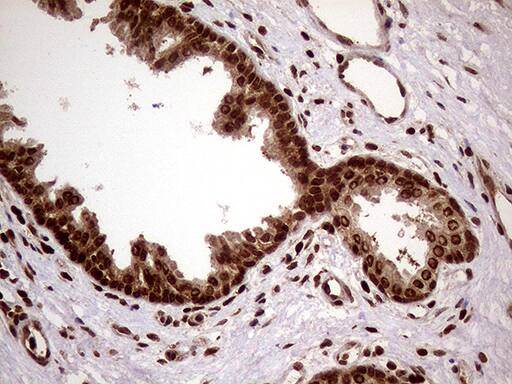 Immunohistochemical staining of paraffin-embedded Carcinoma of Human prostate tissue using anti-DDX19A mouse monoclonal antibody. Heat-induced epitope retrieval by EDTA solution buffer pH 8.0 at 120Â°C for 3 min.