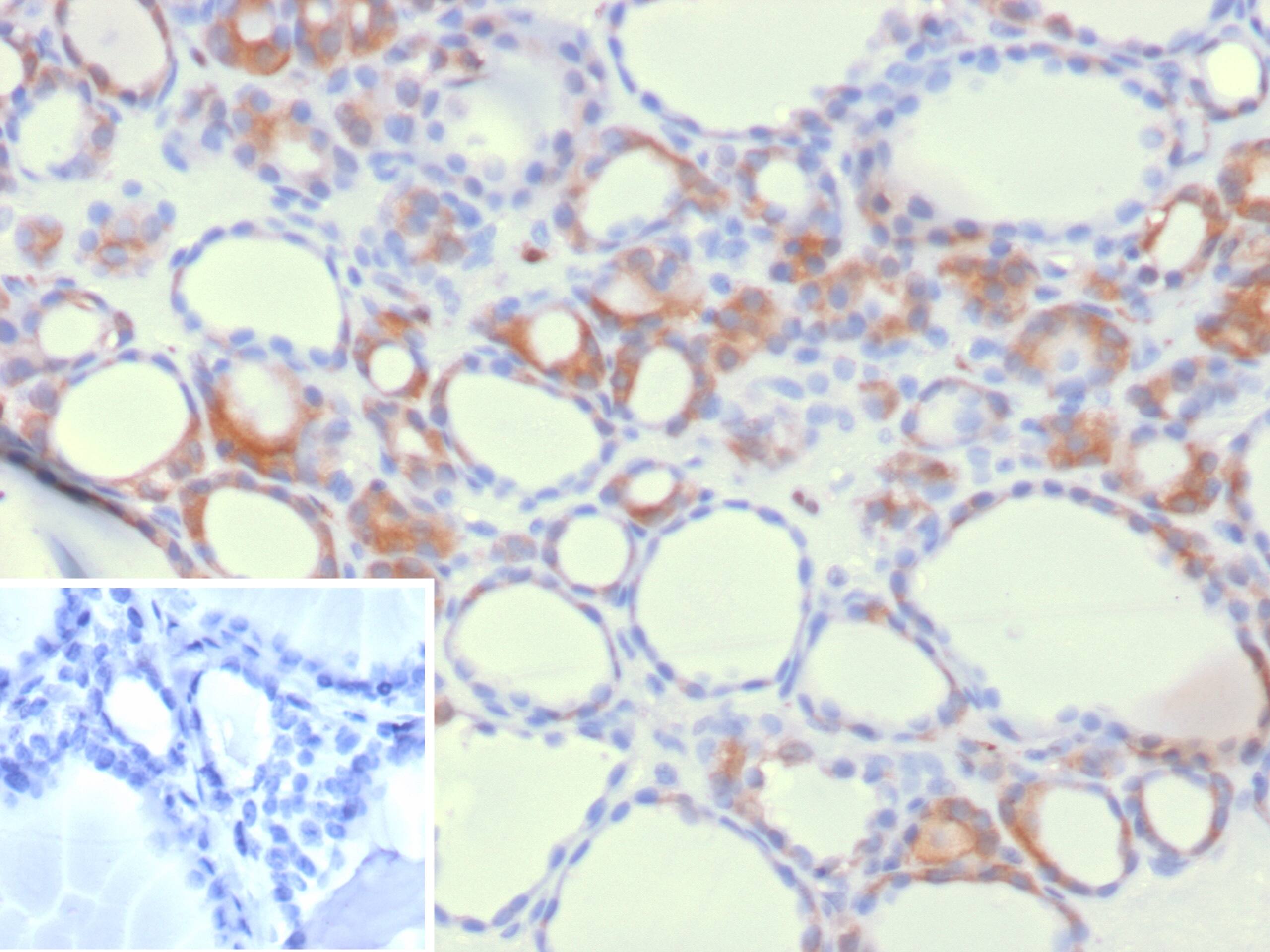 Formalin-fixed, paraffin-embedded human thyroid stained with HEG1 Antibody (HEG1/9445) - Azide and BSA Free. Inset: PBS instead of primary antibody; secondary only negative control.