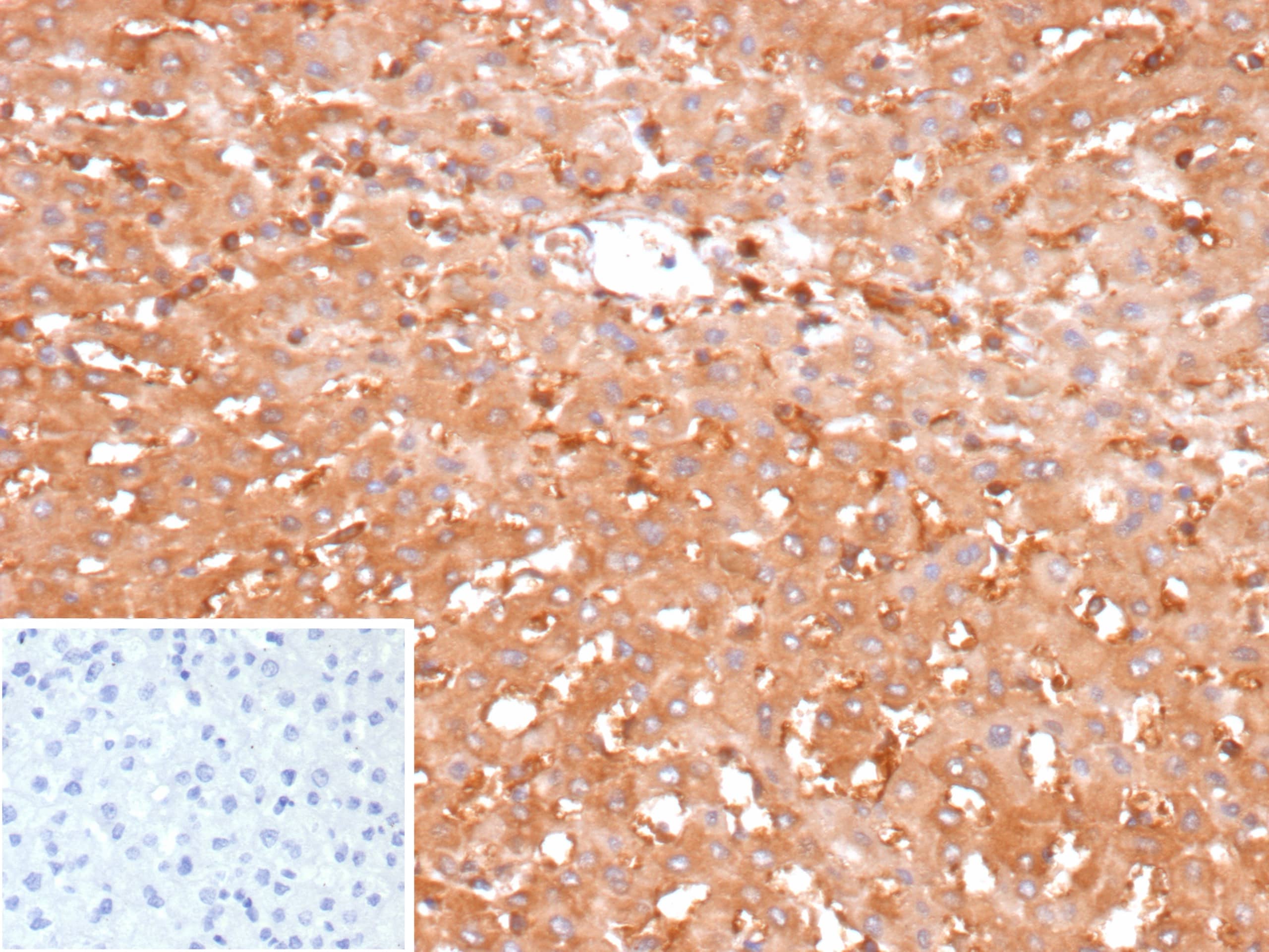Formalin-fixed, paraffin-embedded human hepatocellular carcinoma stained with Glucose 6 phosphate isomerase Antibody (GPI/2439) - Azide and BSA Free.Inset: PBS instead of primary antibody; secondary only negative control.