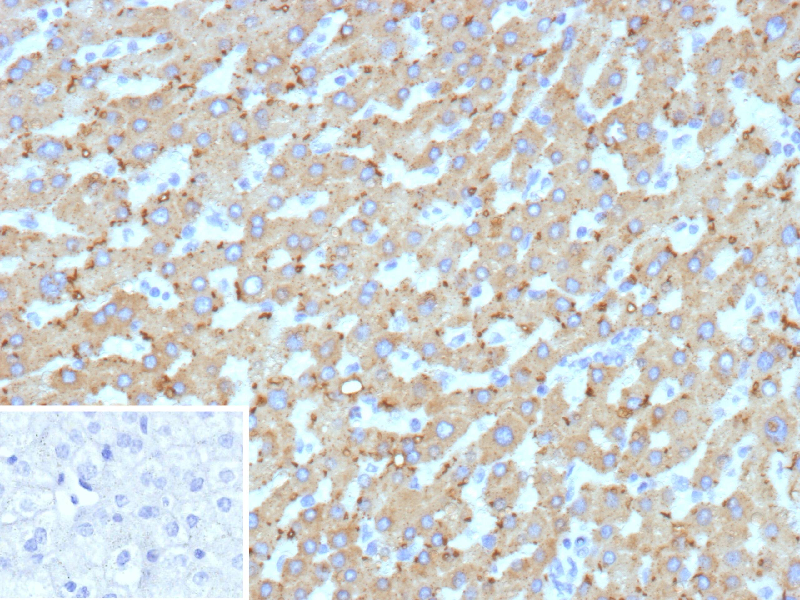 Formalin-fixed, paraffin-embedded human hepatocellular carcinoma stained with HSD17B13 Antibody (HSD17B13/13110) - Azide and BSA Free. Inset: PBS instead of primary antibody; secondary only negative control.