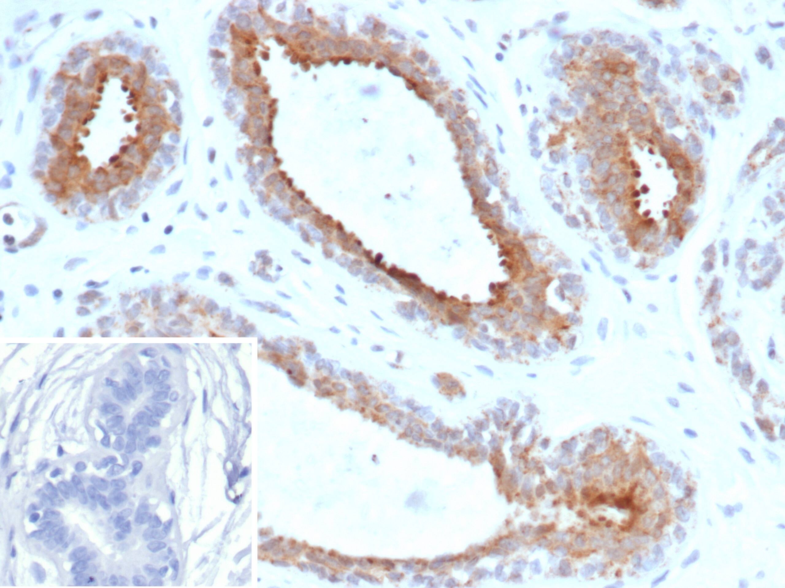 Formalin-fixed, paraffin-embedded human breast carcinoma stained with BAP1 Antibody (BAP1/13501R) - Azide and BSA Free. Inset: PBS instead of primary antibody; secondary only negative control.