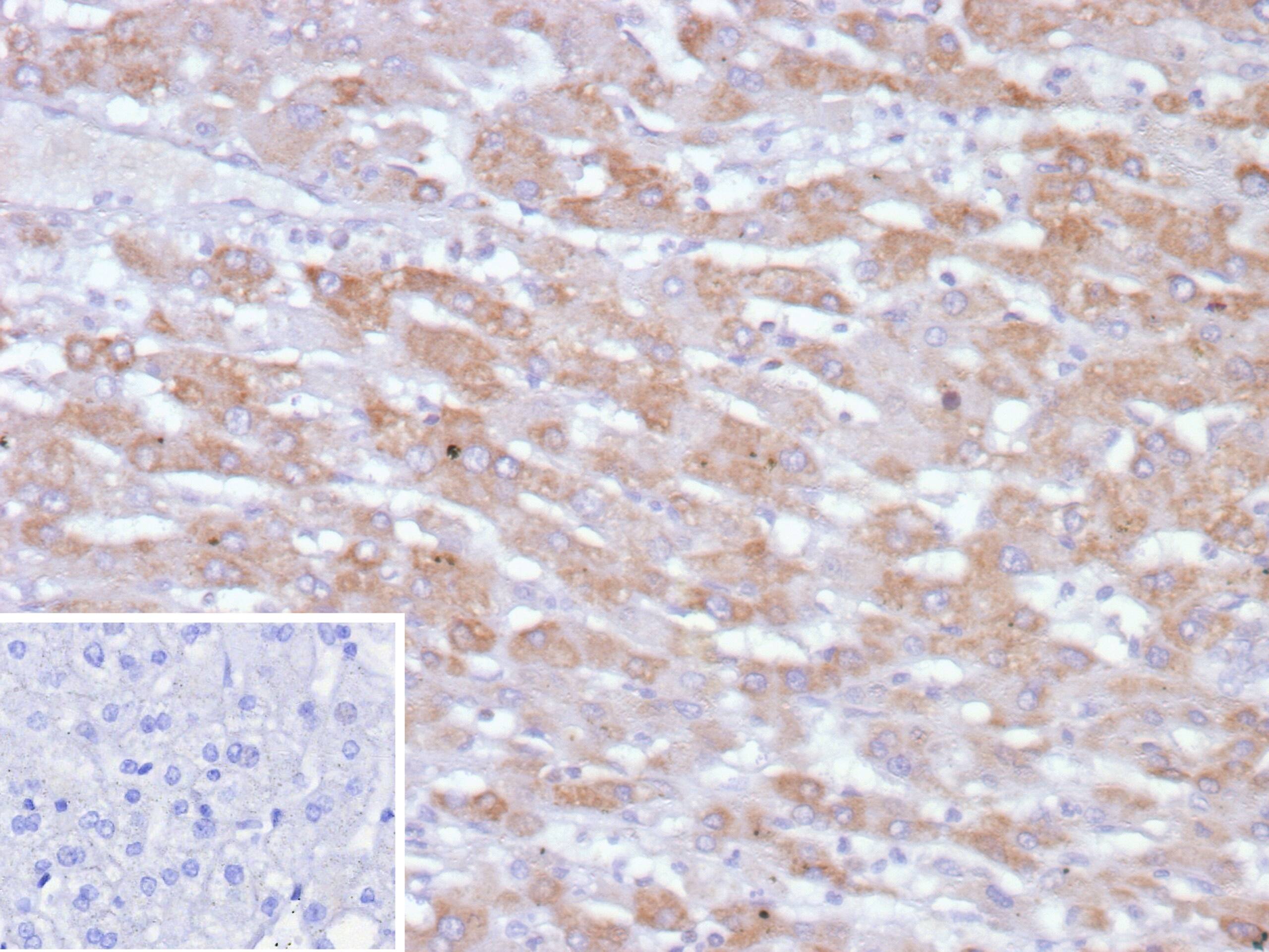 Formalin-fixed, paraffin-embedded human hepatocellular carcinoma stained with PHPT1 Antibody (PHPT1/12053) - Azide and BSA Free. Inset: PBS instead of primary antibody; secondary only negative control.