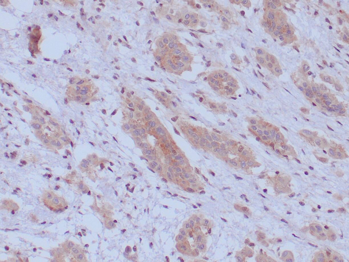 Formalin-fixed, paraffin-embedded human mesothelioma stained with BAP1 Antibody (BAP1/13501R) - Azide and BSA Free. HIER: Tris/EDTA, pH9.0, 45min. 2 : HRP-polymer, 30min. DAB, 5min.