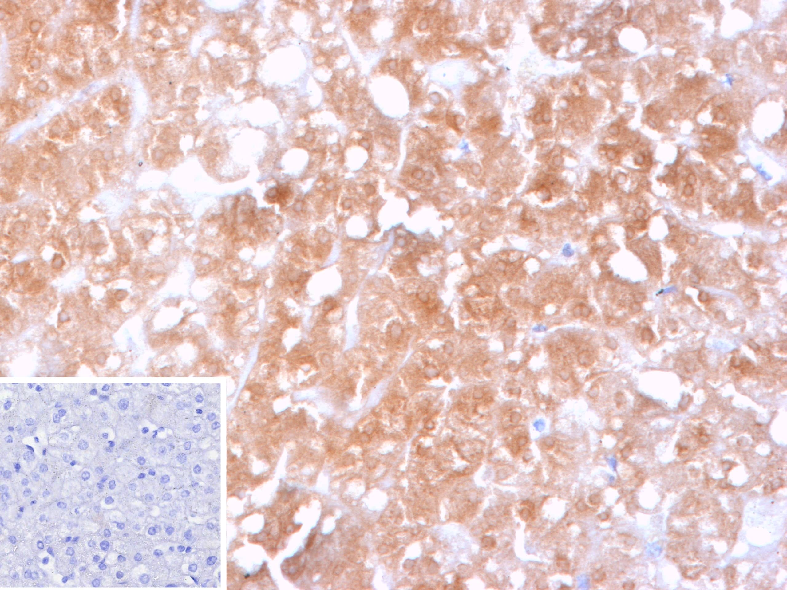 Formalin-fixed, paraffin-embedded human hepatocellular carcinoma (HCC) stained with Cytochrome P450 2C9 Antibody (CYP2C9/13121) - Azide and BSA Free. Inset: PBS instead of primary antibody; secondary only negative control.