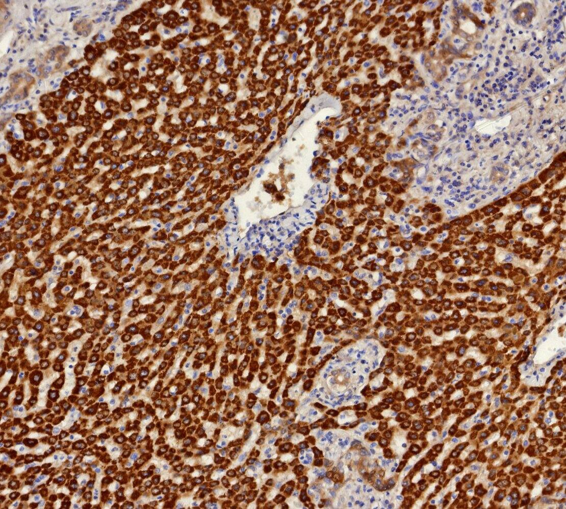 Formalin-fixed, paraffin-embedded human hepatocellular carcinoma stained with Aldo-keto Reductase 1C1/AKR1C1 Antibody (AKR1C1/9314) - Azide and BSA Free. HIER: Tris/EDTA, pH9.0, 45min. 2 : HRP-polymer, 30min. DAB, 5min.