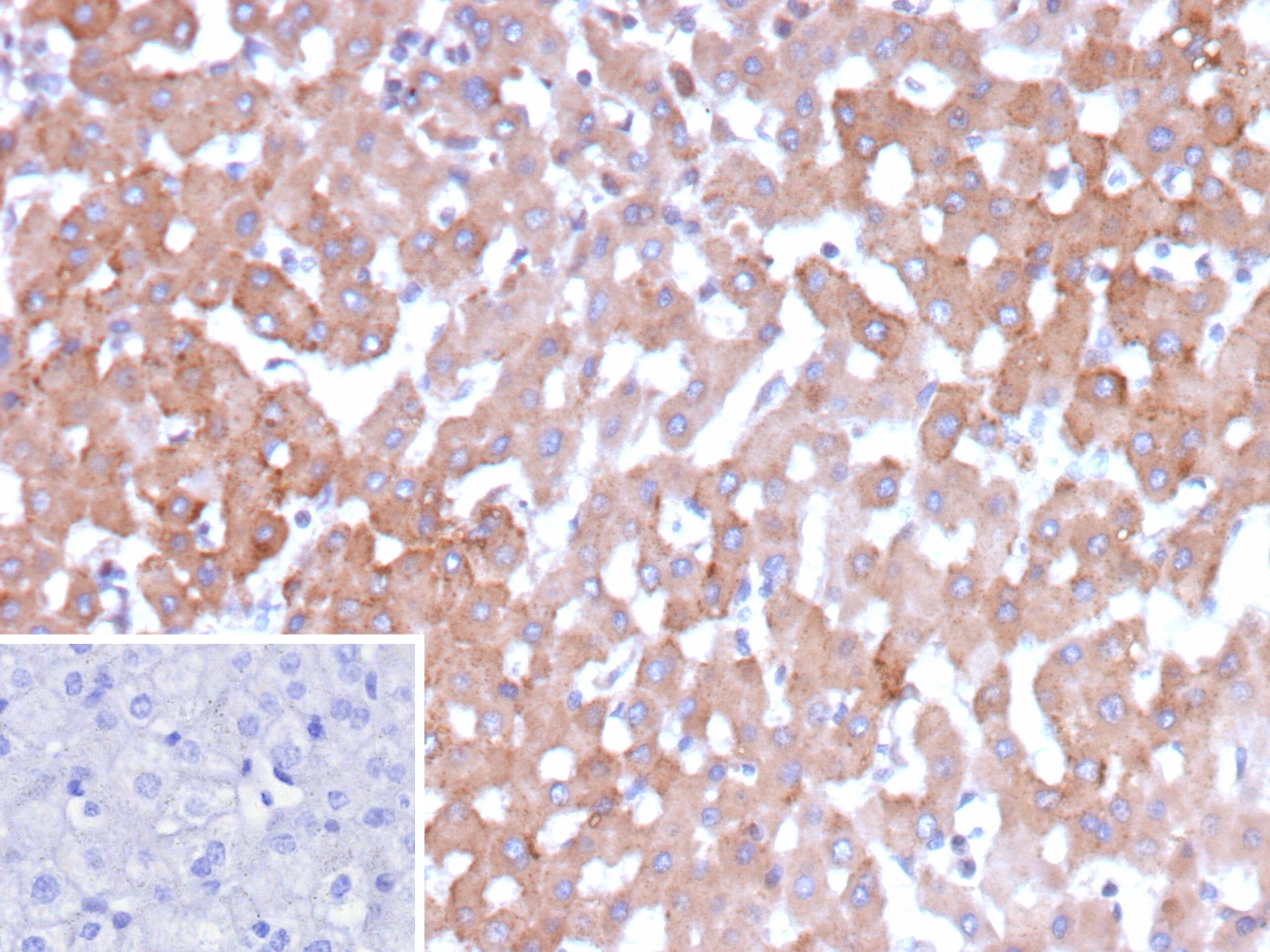 Formalin-fixed, paraffin-embedded human hepatocellular carcinoma stained with HSD17B13 Antibody (HSD17B13/13109) - Azide and BSA Free. Inset: PBS instead of primary antibody; secondary only negative control.