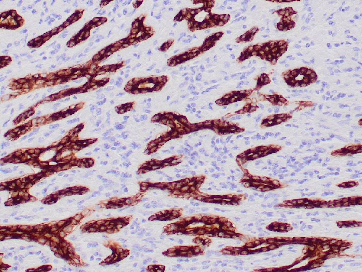 Formalin-fixed, paraffin-embedded human breast carcinoma stained with Cytokeratin 7, 8 Antibody (CAM5.2) - Azide and BSA Free. HIER: Tris/EDTA, pH9.0, 45min. 2 : HRP-polymer, 30min. DAB, 5min.