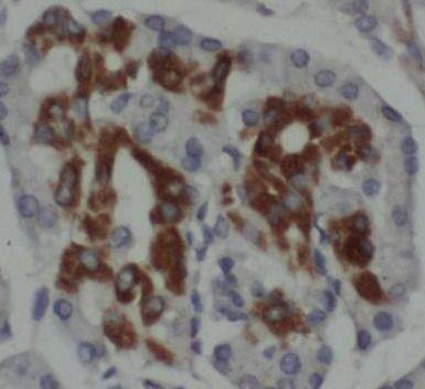 Immunohistochemistry: TMPRSS4 Antibody - BSA Free [NBP3-45180] - Immunohistochemistry of paraffin-embedded human pancreas cancer tissue slide using (TMPRSS4 Antibody) at dilution of 1:200