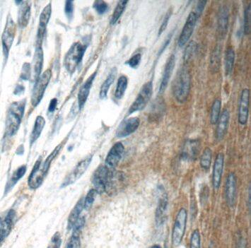 Immunohistochemistry: TMPRSS3 Antibody - BSA Free [NBP3-45181] - Immunohistochemistry of paraffin-embedded human skin cancer tissue slide using (TMPRSS3 antibody) at dilution of 1:50