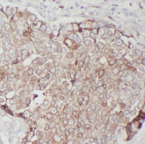 Immunohistochemistry: TMEM199 Antibody - BSA Free [NBP3-45203] - Immunohistochemistry of paraffin-embedded human breast cancer tissue slide using (TMEM199 Antibody) at dilution of 1:50