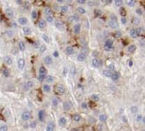 Immunohistochemistry: TMEM181 Antibody - BSA Free [NBP3-45208] - Immunohistochemistry of paraffin-embedded human liver cancer tissue slide using (TMEM181 Antibody) at dilution of 1:50