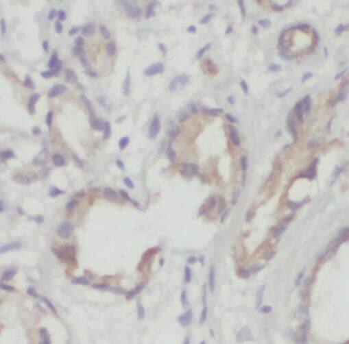 Immunohistochemistry: TM7SF2 Antibody - BSA Free [NBP3-45233] - Immunohistochemistry of paraffin-embedded human prostate cancer using (TM7SF2 antibody) at dilution of 1:50