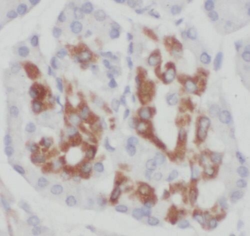 Immunohistochemistry: TIMM9 Antibody - BSA Free [NBP3-45236] - Immunohistochemistry of paraffin-embedded human pancreas cancer using (TIMM9 antibody) at dilution of 1:100
