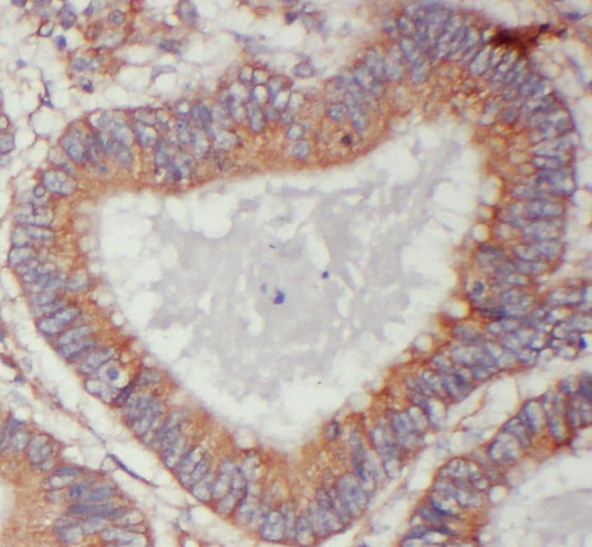 Immunohistochemistry: TIMM10 Antibody - BSA Free [NBP3-45239] - Immunohistochemistry of paraffin-embedded human colon cancer using (TIMM10 antibody) at dilution of 1:50