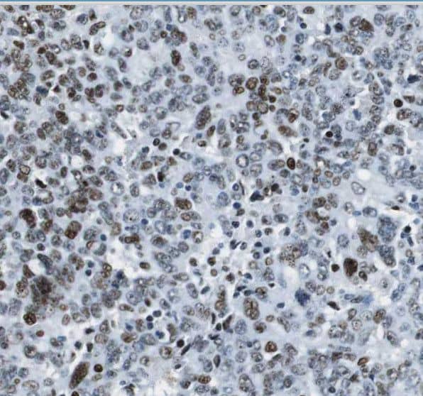Immunohistochemistry: WDR58 Antibody - BSA Free [NBP3-45246] - Immunohistochemistry of paraffin-embedded human ovary tumor using (WDR58 antibody) at dilution of 1:50