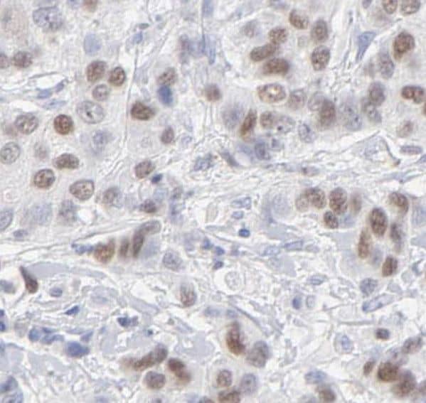 Immunohistochemistry: THOC5 Antibody - BSA Free [NBP3-45247] - Immunohistochemistry of paraffin-embedded human breast cancer tissue slide using (THOC5 Antibody) at dilution of 1:50