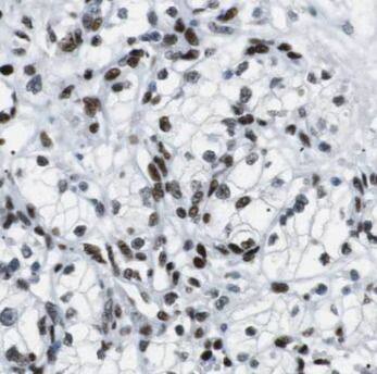 Immunohistochemistry: Elongin A Antibody - BSA Free [NBP3-45280] - Immunohistochemistry of paraffin-embedded human kidney cancer using (Elongin A antibody) at dilution of 1:100