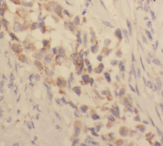 Immunohistochemistry: TACC2 Antibody - BSA Free [NBP3-45303] - Immunohistochemistry of paraffin-embedded human lung cancer using (TACC2 antibody) at dilution of 1:100