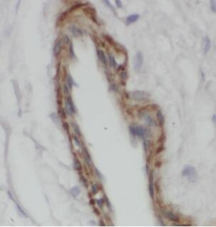 Immunohistochemistry: Arylsulfatase D Antibody - BSA Free [NBP3-45306] - Immunohistochemistry of paraffin-embedded human breast cancer using (Arylsulfatase D antibody) at dilution of 1:50