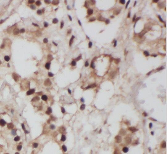 Immunohistochemistry: SLC38A1 Antibody - BSA Free [NBP3-45312] - Immunohistochemistry of paraffin-embedded human prostate cancer using (SLC38A1 antibody) at dilution of 1:50