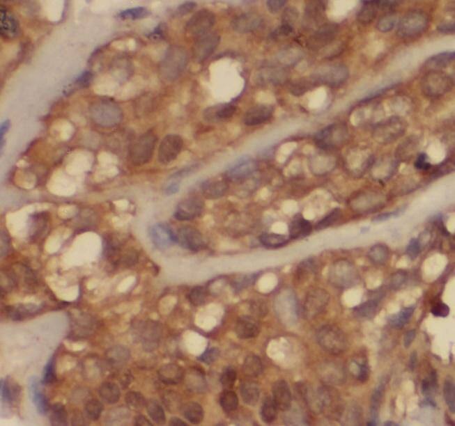 Immunohistochemistry: SH3PXD2A Antibody - BSA Free [NBP3-45362] - Immunohistochemistry of paraffin-embedded human breast cancer using (SH3PXD2A antibody) at dilution of 1:50