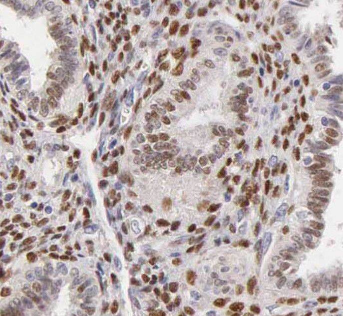 Immunohistochemistry: SH3BP5 Antibody - BSA Free [NBP3-45363] - Immunohistochemistry of paraffin-embedded human ovary tumor using (SH3BP5 antibody) at dilution of 1:50