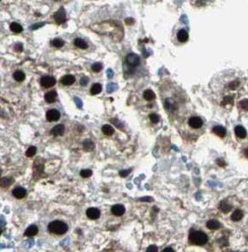 Immunohistochemistry: CCDC101 Antibody - BSA Free [NBP3-45371] - Immunohistochemistry of paraffin-embedded human liver cancer tissue slide using (CCDC101 Antibody) at dilution of 1:400