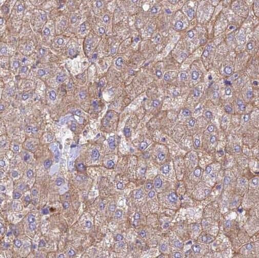 Immunohistochemistry: SERINC1 Antibody - BSA Free [NBP3-45392] - Immunohistochemistry of paraffin-embedded human liver cancer using (SERINC1 antibody) at dilution of 1:50