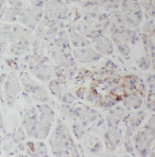 Immunohistochemistry: SERCA3 ATPase Antibody - BSA Free [NBP3-45393] - Immunohistochemistry of paraffin-embedded human pancreas cancer using (SERCA3 ATPase antibody) at dilution of 1:100