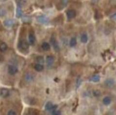 Immunohistochemistry: Septin-6 Antibody - BSA Free [NBP3-45396] - Immunohistochemistry of paraffin-embedded human cervical cancer using (SEPT6 antibody) at dilution of 1:100