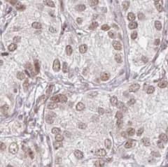 Immunohistochemistry: SENP5 Antibody - BSA Free [NBP3-45399] - Immunohistochemistry of paraffin-embedded human cervical cancer using (SENP5 antibody) at dilution of 1:100