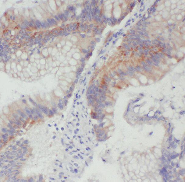 Immunohistochemistry: SDCCAG3 Antibody - BSA Free [NBP3-45418] - Immunohistochemistry of paraffin-embedded human colon cancer using (SDCCAG3 antibody) at dilution of 1:50