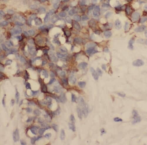 Immunohistochemistry: SAMD9L Antibody - BSA Free [NBP3-45448] - Immunohistochemistry of paraffin-embedded human breast cancer tissue slide using (SAMD9L Antibody) at dilution of 1:50