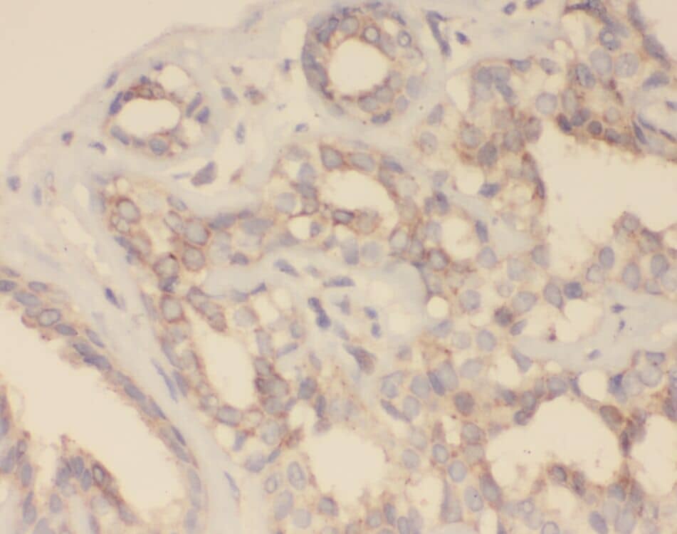 Immunohistochemistry: Zinc finger protein 395 Antibody - BSA Free [NBP3-45469] - Immunohistochemistry of paraffin-embedded human pancreas cancer using (Zinc finger protein 395 antibody) at dilution of 1:100