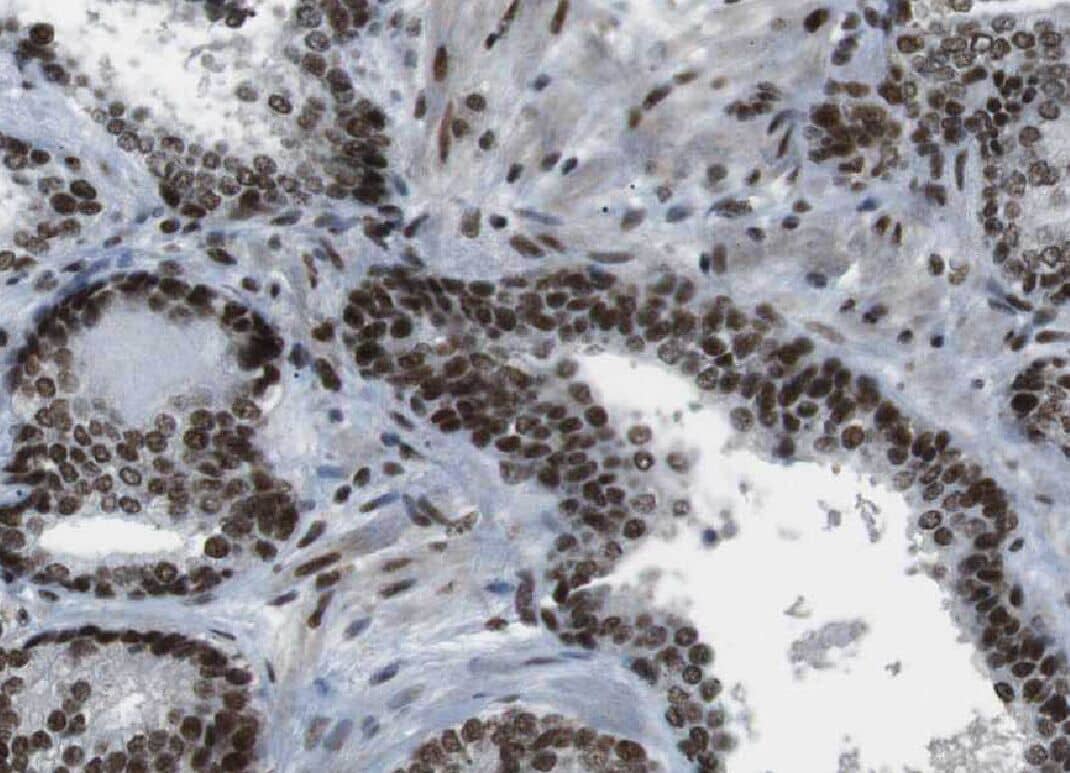 Immunohistochemistry: YPEL5 Antibody - BSA Free [NBP3-45529] - Immunohistochemistry of paraffin-embedded human prostate cancer using (YPEL5 antibody) at dilution of 1:25