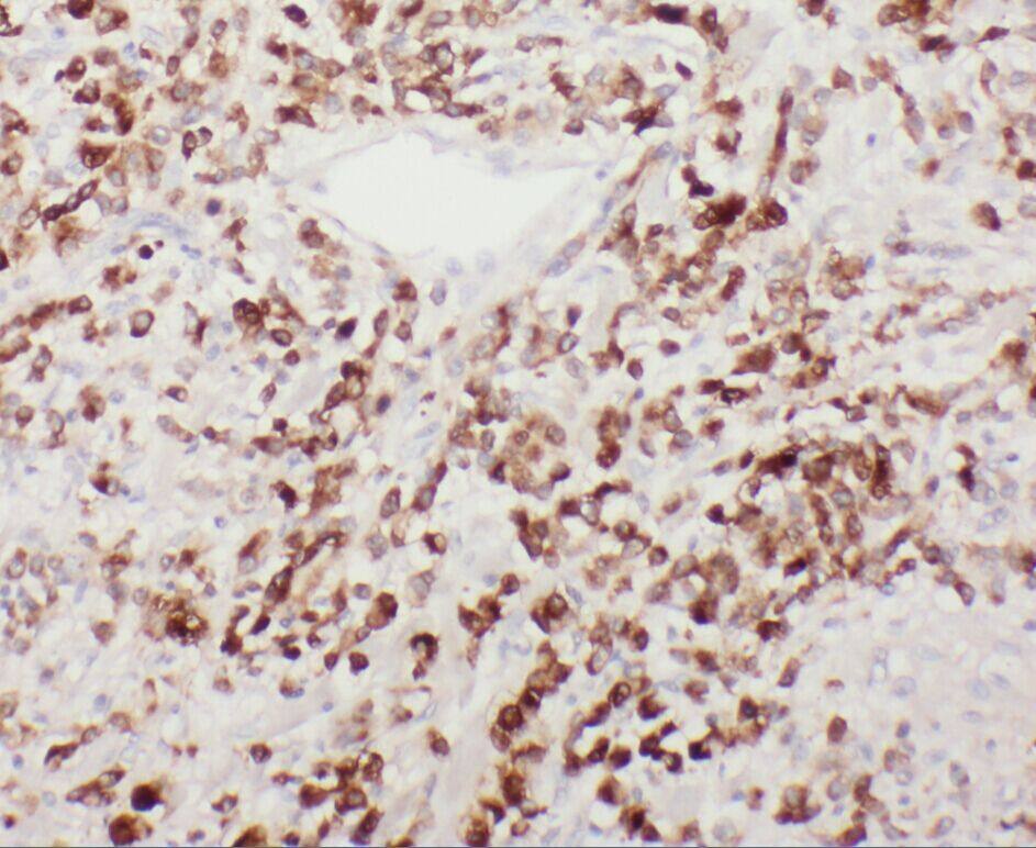 Immunohistochemistry: YIPF4 Antibody - BSA Free [NBP3-45533] - Immunohistochemistry of paraffin-embedded human endometrial cancer using (YIPF4 antibody) at dilution of 1:50