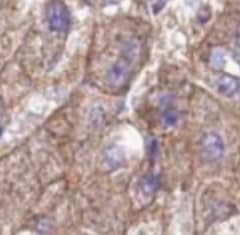 Immunohistochemistry: FRMD6 Antibody - BSA Free [NBP3-45549] - Immunohistochemistry of paraffin-embedded human liver cancer using (FRMD6 antibody) at dilution of 1:50