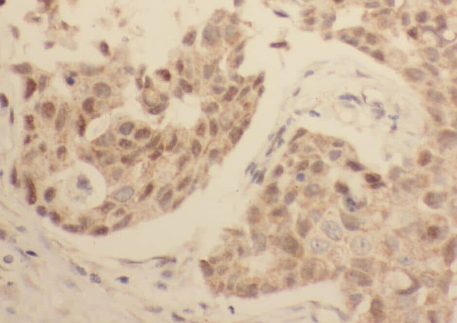 Immunohistochemistry: WDR38 Antibody - BSA Free [NBP3-45561] - Immunohistochemistry of paraffin-embedded human breast cancer tissue slide using (WDR38 Antibody) at dilution of 1:50