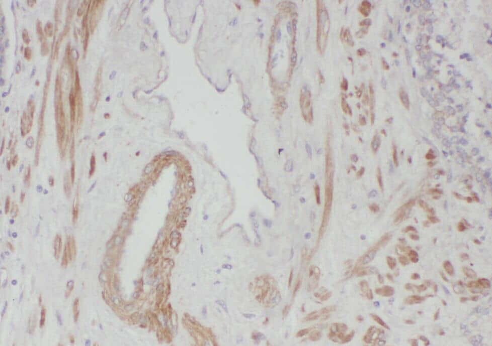Immunohistochemistry: WDR19 Antibody - BSA Free [NBP3-45567] - Immunohistochemistry of paraffin-embedded human prostate cancer tissue slide using (WDR19 Antibody) at dilution of 1:50