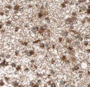 Immunohistochemistry: URG4 Antibody - BSA Free [NBP3-45633] - Immunohistochemistry of paraffin-embedded human gliomas using (URG4 antibody) at dilution of 1:50