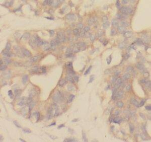 Immunohistochemistry: UQCRB Antibody - BSA Free [NBP3-45636] - Immunohistochemistry of paraffin-embedded human breast cancer using (UQCRB antibody) at dilution of 1:100