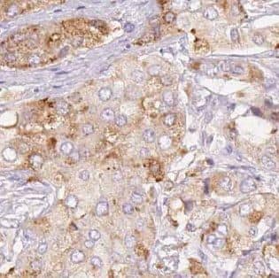 Immunohistochemistry: KIST Antibody - BSA Free [NBP3-45646] - Immunohistochemistry of paraffin-embedded human prostate cancer using (KIST antibody) at dilution of 1:50