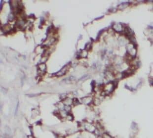 Immunohistochemistry: UGCG Antibody - BSA Free [NBP3-45651] - Immunohistochemistry of paraffin-embedded human lung cancer using (UGCG antibody) at dilution of 1:100