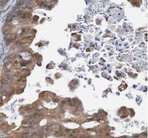 Immunohistochemistry: TULP3 Antibody - BSA Free [NBP3-45680] - Immunohistochemistry of paraffin-embedded human ovary tumor using (TULP3 antibody) at dilution of 1:100