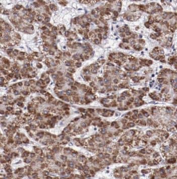 Immunohistochemistry: p53 DINP1 Antibody - BSA Free [NBP3-45755] - Immunohistochemistry of paraffin-embedded human liver cancer tissue slide using (p53 DINP1 antibody) at dilution of 1:50