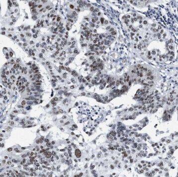 Immunohistochemistry: SYCE1 Antibody - BSA Free [NBP3-45774] - Immunohistochemistry of paraffin-embedded human ovary tumor using (SYCE1 antibody) at dilution of 1:100